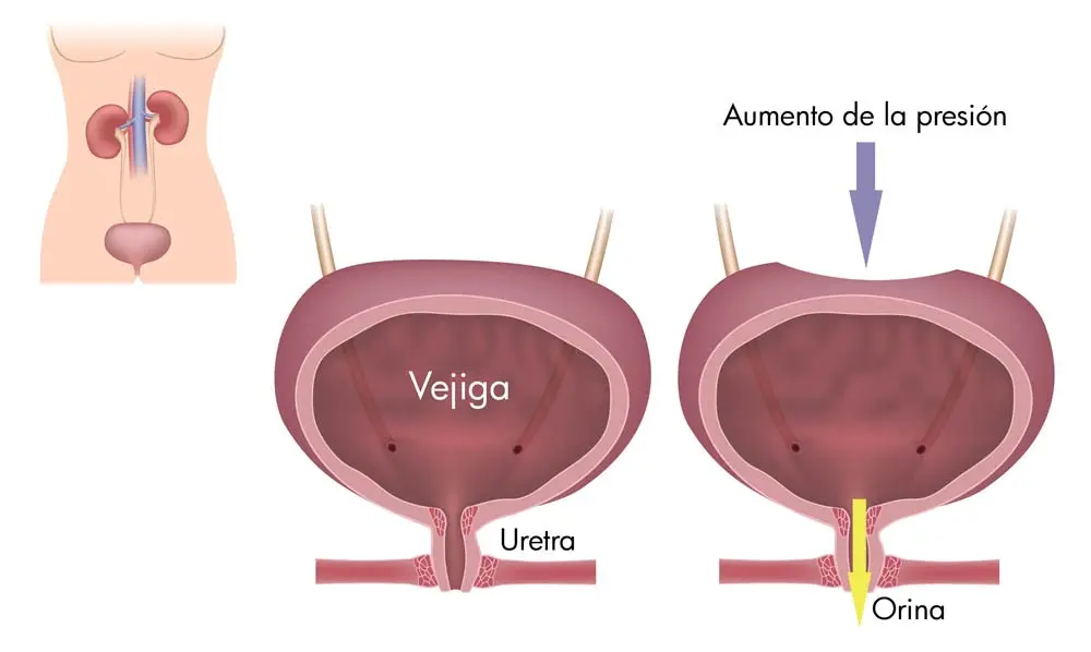 incontinencia urinaria psicologia - Cómo afecta el estrés al sistema urinario