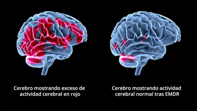 emdr psicologia - Cómo se aplica la terapia EMDR