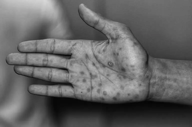 sifilis consecuencias fisicas y psicologicas - Cuáles son los síntomas de la sífilis en los hombres