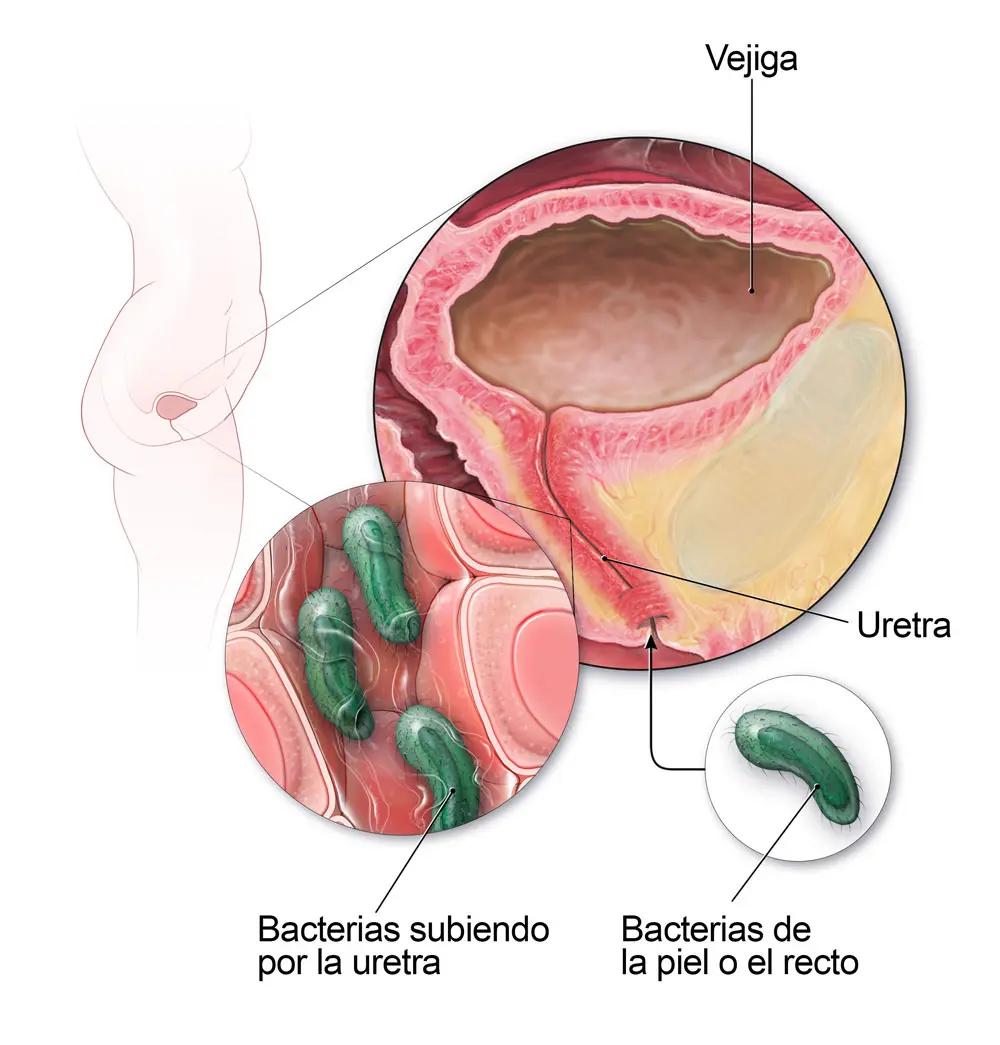 infeccion urinaria psicologia - Por qué tengo tantas infecciones urinarias