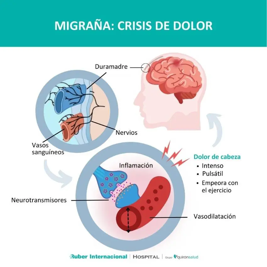 causas psicologicas de la migraña - Qué emociones están relacionadas con la migraña