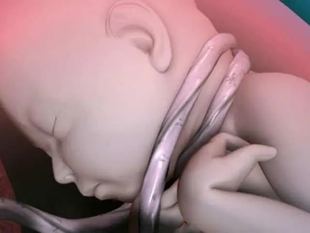 consecuencias psicológicas del fórceps - Qué es desventaja de cara al parto