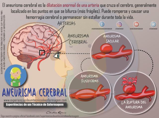 aneurisma psicologia - Qué es un aneurisma en el cerebro