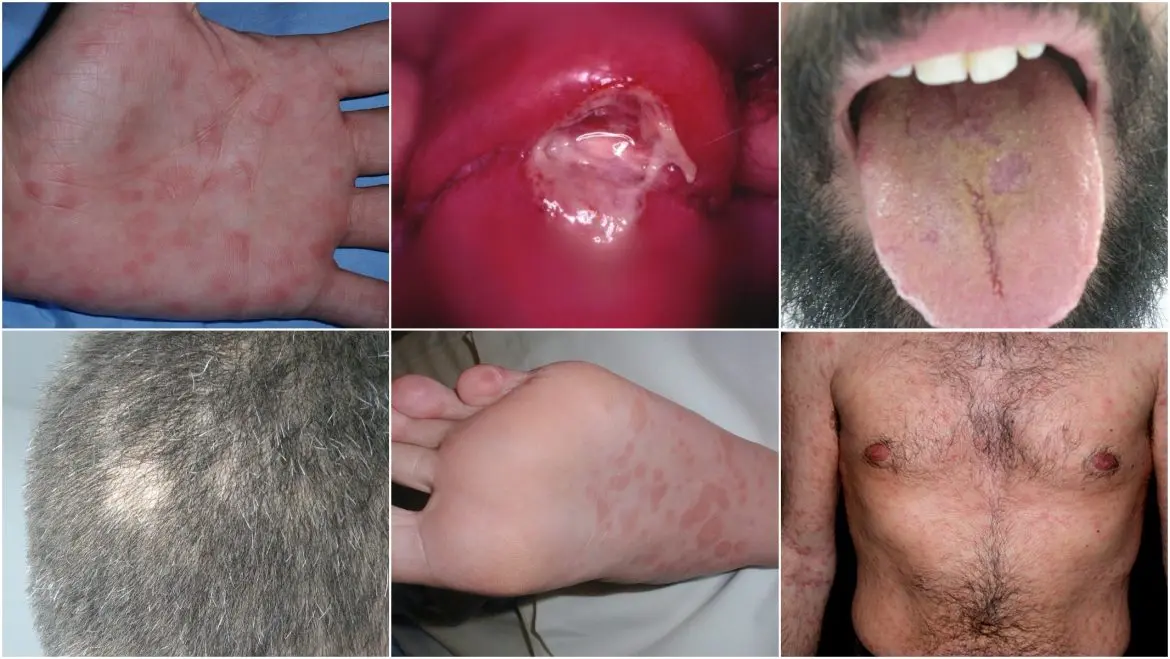 sifilis consecuencias fisicas y psicologicas - Qué secuelas te deja la sífilis